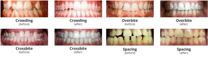 invisalign before and after spacing