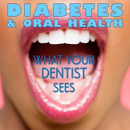 Des Moines dentist, Dr. Chad Johnson of Veranda Dentistry, discusses the side effects of diabetes and how it affects your oral health.