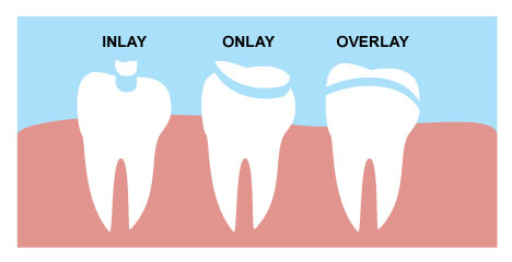 Restorative - Veranda Dentistry - Cerec Crowns Des Moines